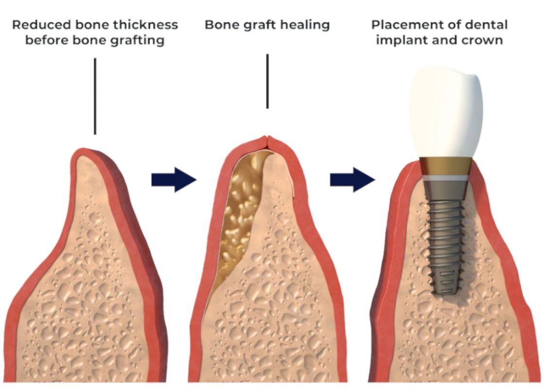 All about dental bone grafts